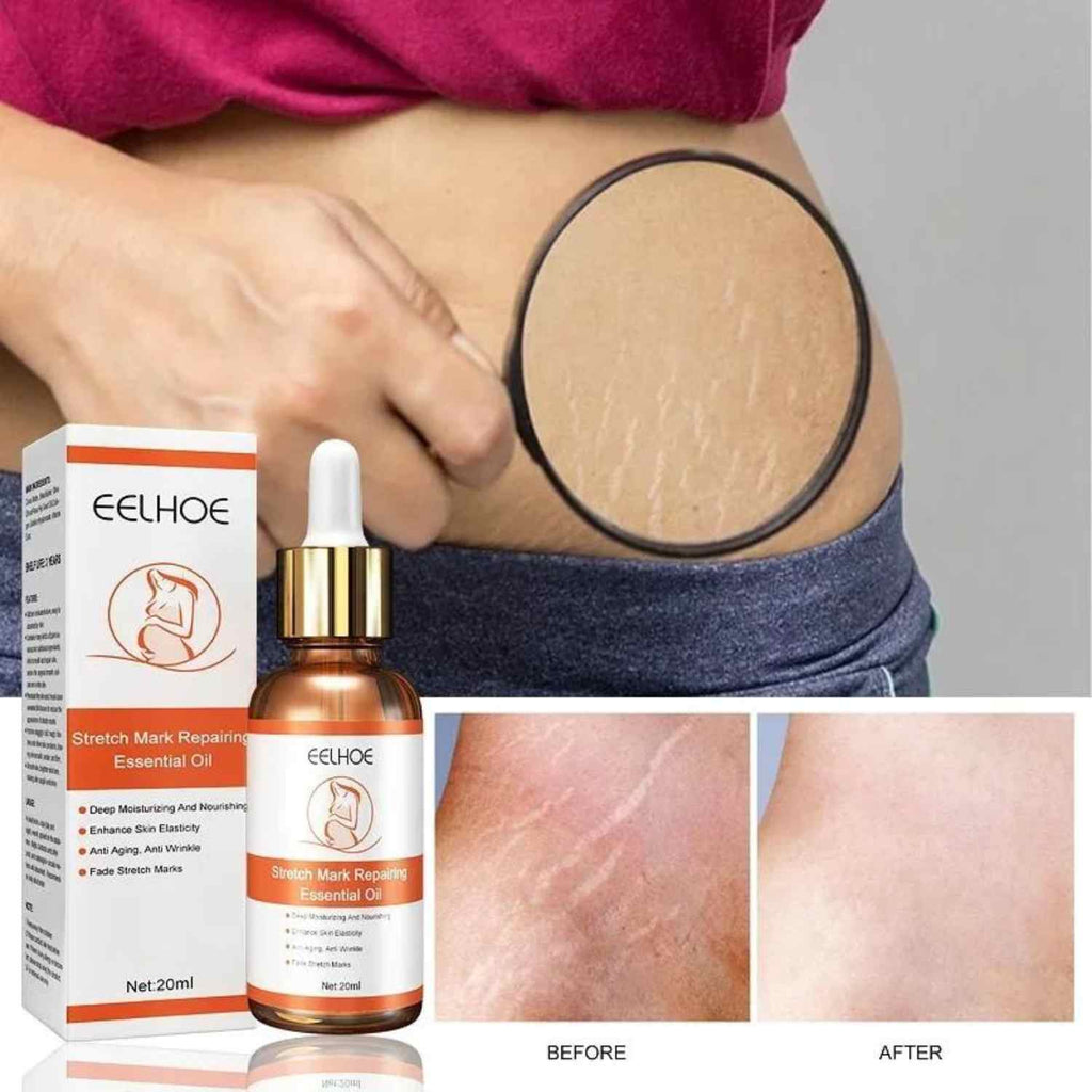 Stretch Marks Treatment Repair